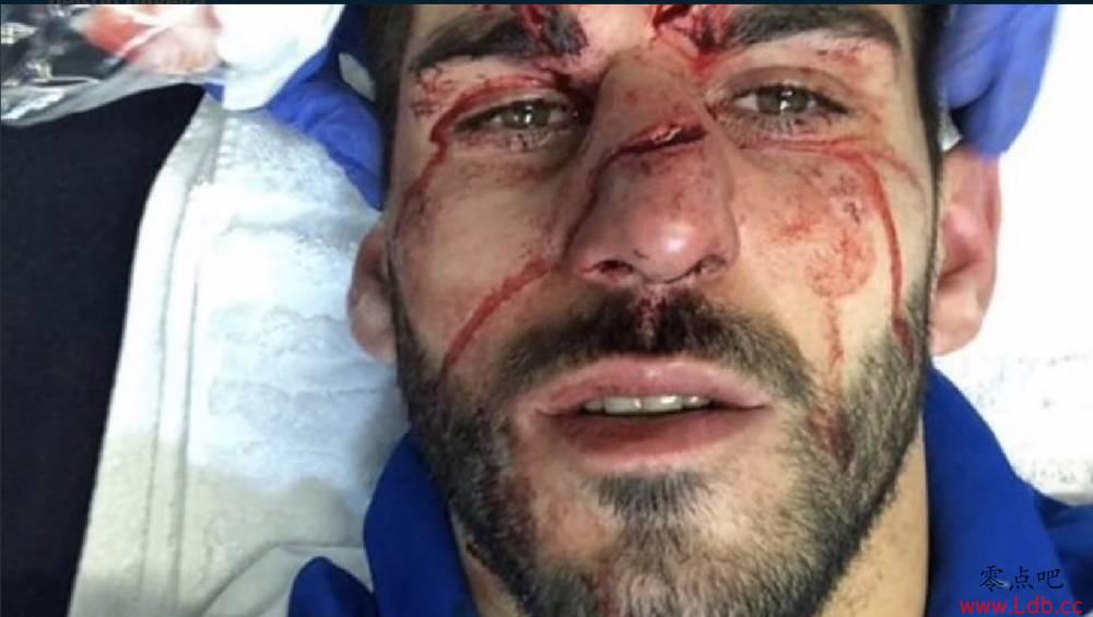 太吓人！英冠赛场现球鞋踩脸事件 球员脸部严重受伤
