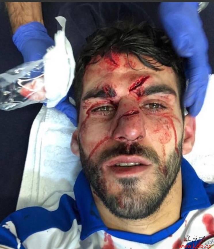 太吓人！英冠赛场现球鞋踩脸事件 球员脸部严重受伤